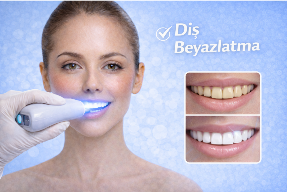 Diş Beyazlatma